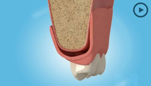 Denture Stabilisation